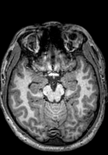 Cerebral arteriovenous malformation at posterior body of corpus callosum (Radiopaedia 74111-84925 Axial T1 193).jpg