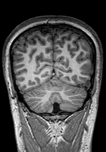 Cerebral arteriovenous malformation at posterior body of corpus callosum (Radiopaedia 74111-84925 Coronal T1 278).jpg
