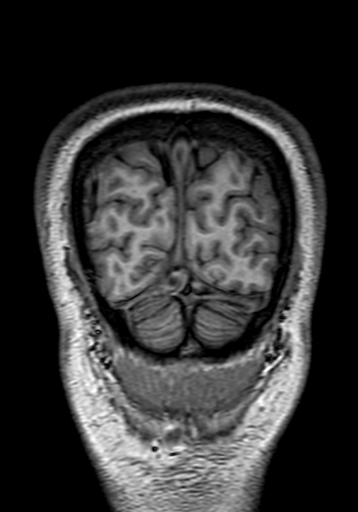 Cerebral arteriovenous malformation at posterior body of corpus callosum (Radiopaedia 74111-84925 Coronal T1 323).jpg