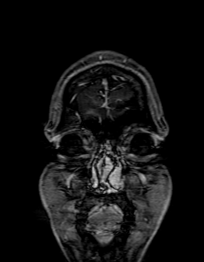 Cerebral arteriovenous malformation at posterior body of corpus callosum (Radiopaedia 74111-84925 K 12).jpg