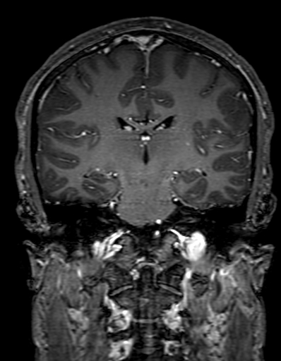 Cerebral arteriovenous malformation at posterior body of corpus callosum (Radiopaedia 74111-84925 K 206).jpg