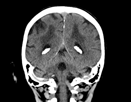 Cerebral arteriovenous malformation with lobar hemorrhage (Radiopaedia 44725-48510 Coronal non-contrast 34).png