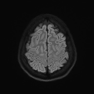 Cerebral cavernous venous malformation (Radiopaedia 70008-80021 Axial DWI 56).jpg
