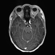 Cerebral cavernous venous malformation (Radiopaedia 70008-80021 Axial T1 C+ 25).jpg