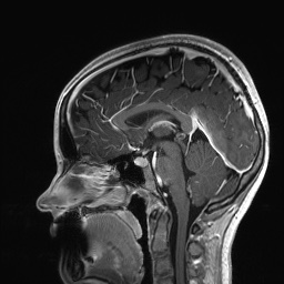 Cerebral cavernous venous malformation (Radiopaedia 70008-80021 Sagittal T1 C+ 36).jpg