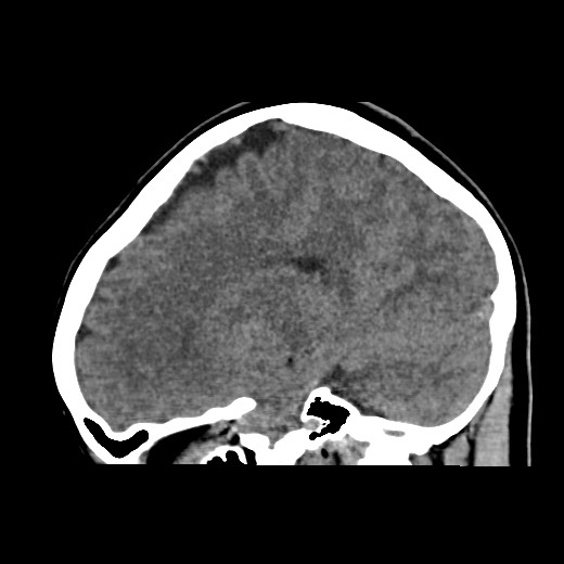 File:Cerebral cavernous venous malformation (Radiopaedia 70008-80022 C 22).jpg