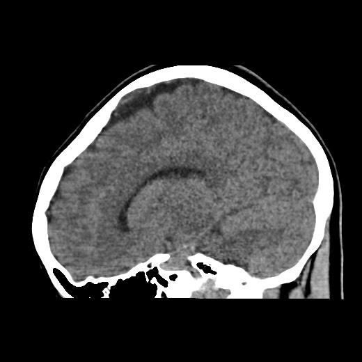 Cerebral cavernous venous malformation (Radiopaedia 70008-80022 C 24).jpg