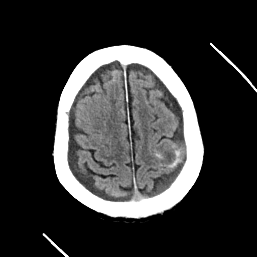File:Cerebral contusions, subarachnoid hemorrhage and subdural hygromas (Radiopaedia 55399-61829 Axial non-contrast 9).png