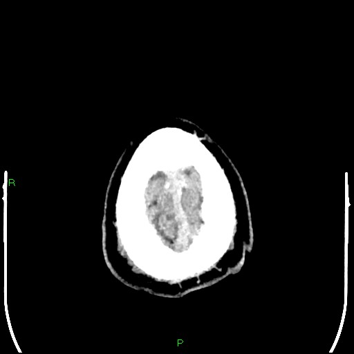 Cerebral contusions (Radiopaedia 33868-35039 Axial non-contrast 210).jpg