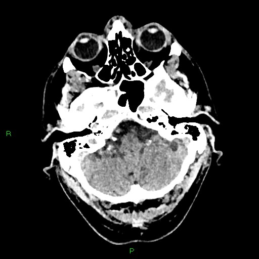 Cerebral contusions (Radiopaedia 33868-35039 Axial non-contrast 35).jpg