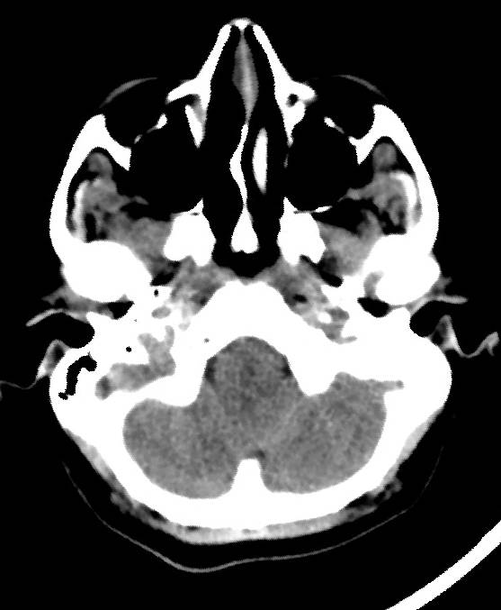 Cerebral edema due to severe hyponatremia (Radiopaedia 89826-106937 Axial non-contrast 13).jpg