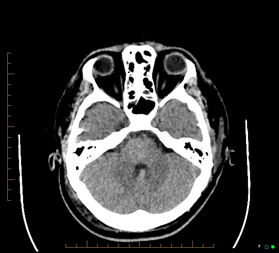Cerebral fat embolism (Radiopaedia 85521-101220 Axial non-contrast 22).jpg