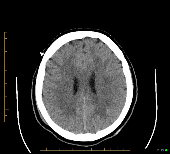 Cerebral fat embolism (Radiopaedia 85521-101220 Axial non-contrast 41).jpg