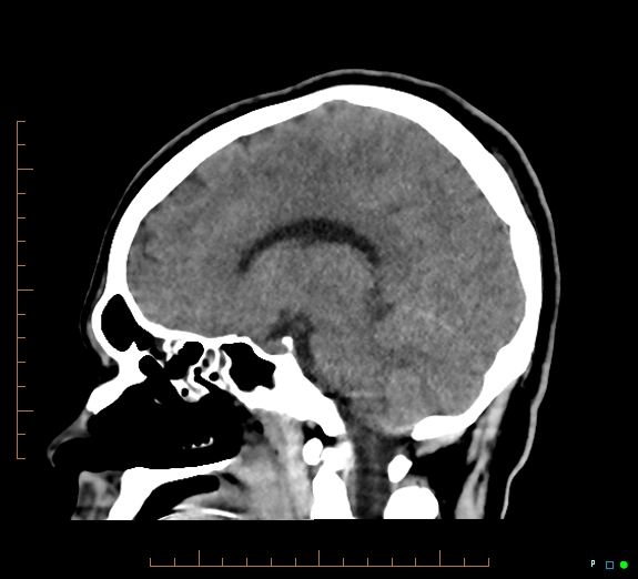 Cerebral fat embolism (Radiopaedia 85521-101220 B 31).jpg