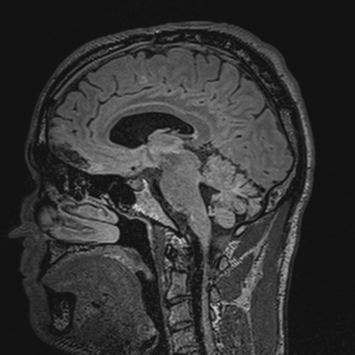 File:Cerebral hemorrhagic contusions- temporal evolution (Radiopaedia 40224-42757 Sagittal T1 38).png