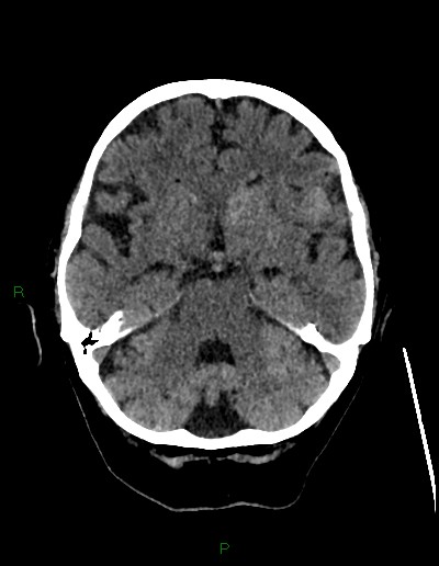 File:Cerebral metastases - ependymal and parenchymal (Radiopaedia 79877-93131 Axial non-contrast 23).jpg