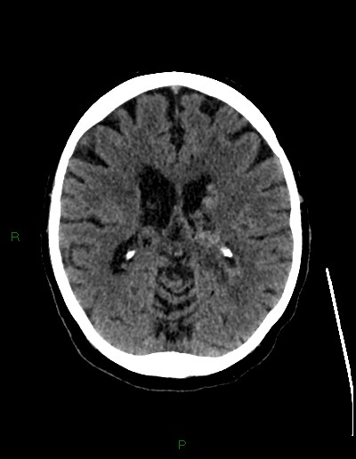 File:Cerebral metastases - ependymal and parenchymal (Radiopaedia 79877-93131 Axial non-contrast 42).jpg