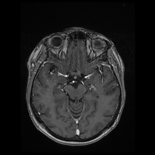 Cerebral metastases - melanoma (Radiopaedia 80972-94522 Axial T1 C+ 48).jpg