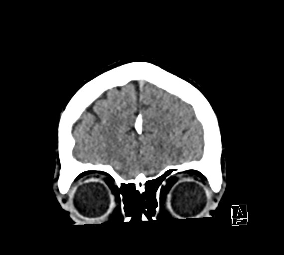 Cerebral metastases - testicular choriocarcinoma (Radiopaedia 84486-99855 Coronal C+ delayed 11).jpg