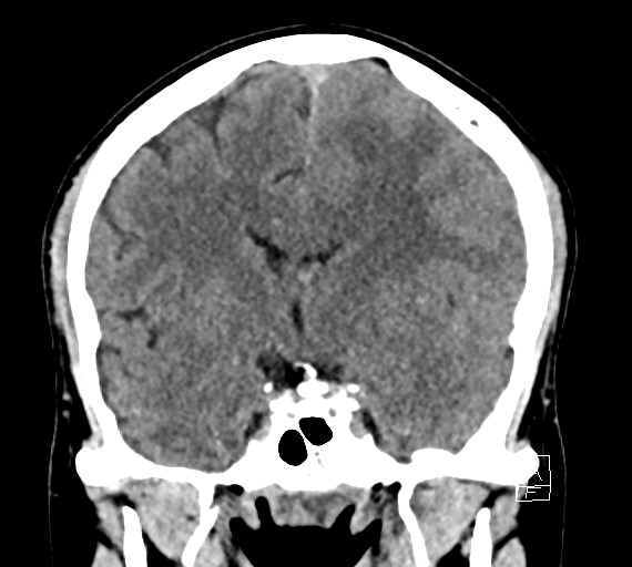 Cerebral metastases - testicular choriocarcinoma (Radiopaedia 84486-99855 Coronal C+ delayed 30).jpg