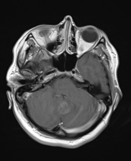 File:Cerebral metastases mimicking abscesses (Radiopaedia 45841-50131 Axial T1 C+ fat sat 8).png