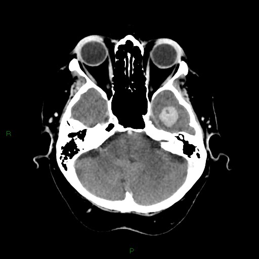 File:Cerebral metastasis from renal cell carcinoma (Radiopaedia 82306-96375 Axial C+ delayed 8).jpg