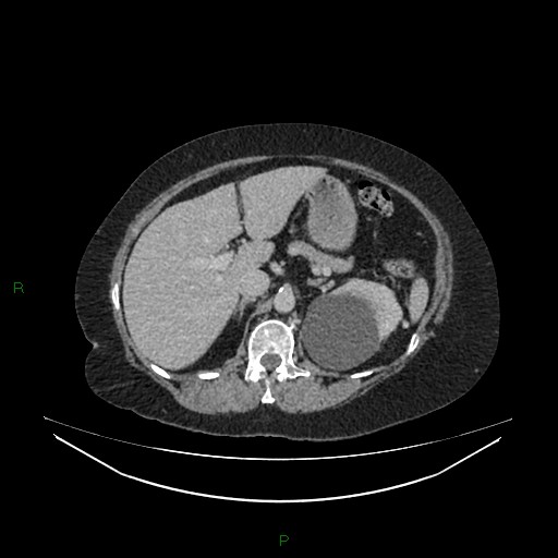 Cerebral metastasis from renal cell carcinoma (Radiopaedia 82306-96378 A 51).jpg