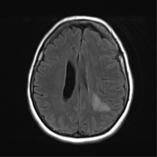 File:Cerebral metastasis mimicking glioblastoma (Radiopaedia 69155-78937 Axial FLAIR 22).png