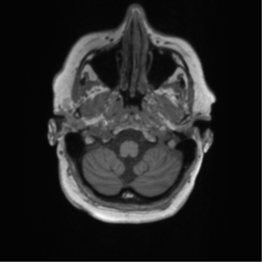 File:Cerebral metastasis mimicking glioblastoma (Radiopaedia 69155-78937 Axial T1 4).png