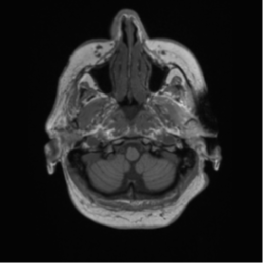Cerebral metastasis to basal ganglia (Radiopaedia 81568-95413 Axial T1 6).png