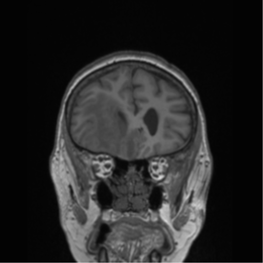 Cerebral metastasis to basal ganglia (Radiopaedia 81568-95413 Coronal T1 47).png
