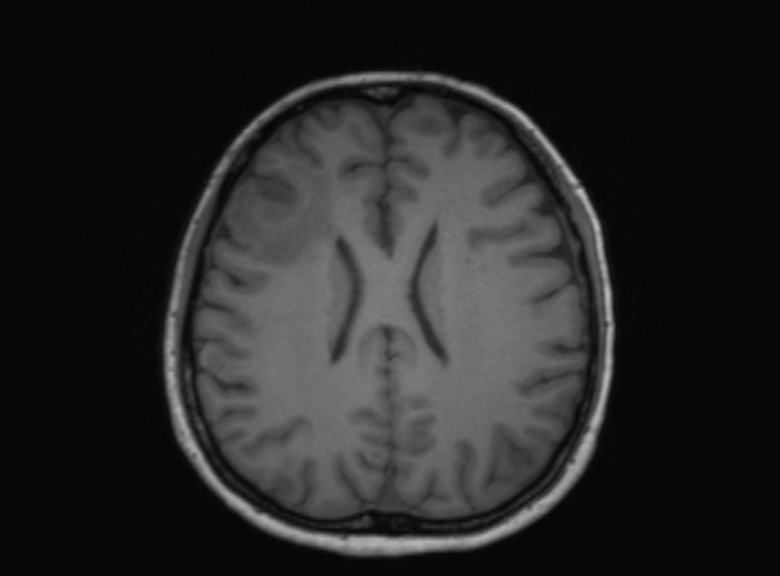 Cerebral ring enhancing lesions - cerebral metastases (Radiopaedia 44922-48817 Axial T1 192).jpg
