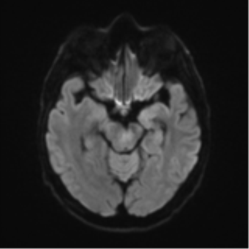 Cerebral toxoplasmosis (Radiopaedia 54575-60804 Axial DWI 46).png