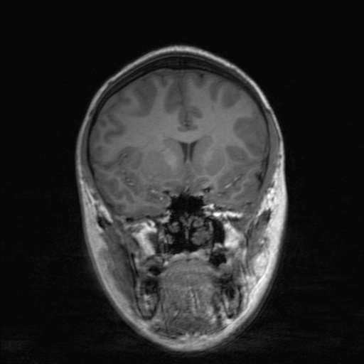 Cerebral tuberculosis with dural sinus invasion (Radiopaedia 60353-68090 Coronal T1 73).jpg