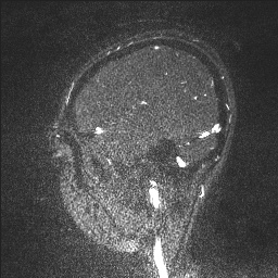 Cerebral tuberculosis with dural sinus invasion (Radiopaedia 60353-68090 Sagittal MRV 126).jpg