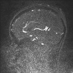 Cerebral tuberculosis with dural sinus invasion (Radiopaedia 60353-68090 Sagittal MRV 79).jpg