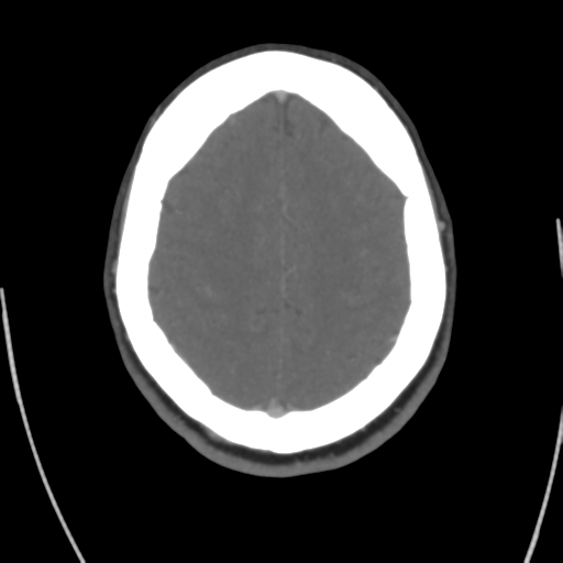 Cerebral venous infarct related to dural venous sinus thromboses (Radiopaedia 35292-36804 Axial C+ delayed 38).png