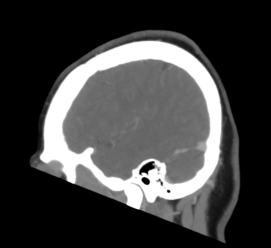 Cerebral venous infarction due to transverse sinus thrombosis (Radiopaedia 34688-36120 Sagittal CT venogram 42).png