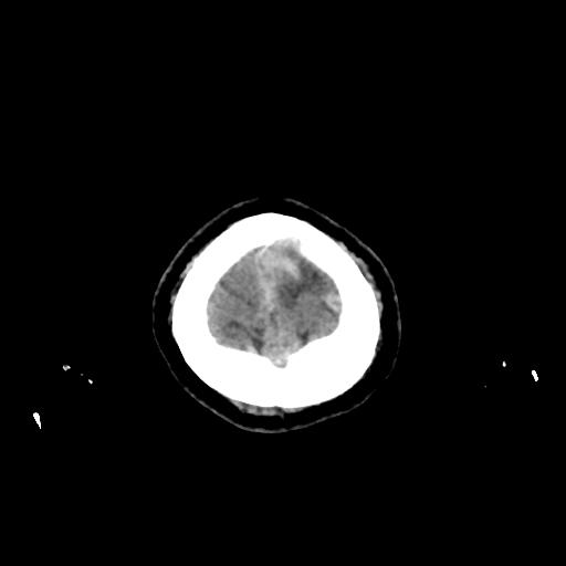 Cerebral venous throbmosis - hemorrhagic venous infarction (Radiopaedia 87318-103613 Axial non-contrast 169).jpg