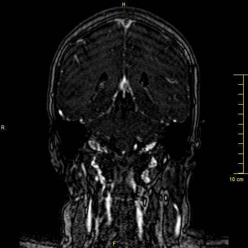 Cerebral venous thrombosis (Radiopaedia 23288-23351 MRV 103).JPG