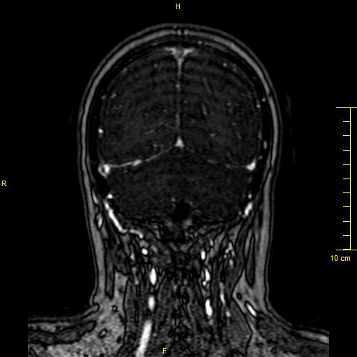 Cerebral venous thrombosis (Radiopaedia 23288-23351 MRV 135).JPG