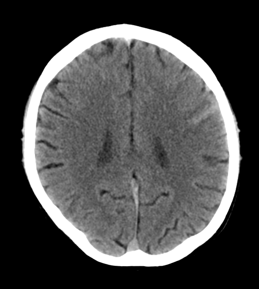 File:Cerebral venous thrombosis (Radiopaedia 38392-40467 Axial non-contrast 18).png