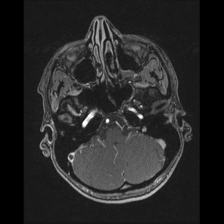 Cerebral venous thrombosis (Radiopaedia 45678-49854 Axial MRV 11).jpg