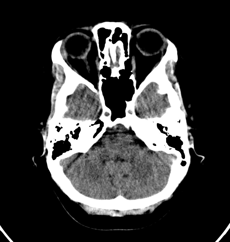 Cerebral venous thrombosis - CT only (Radiopaedia 41031-43778 Axial non-contrast 68).jpg