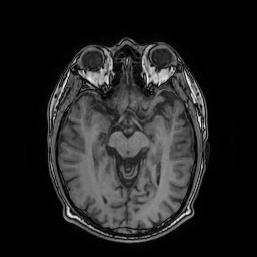Cerebral venous thrombosis with secondary intracranial hypertension (Radiopaedia 89842-106957 Axial T1 83).jpg