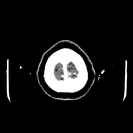 Cerebral venous thrombosis with venous hemorrhagic infarct (Radiopaedia 90354-107660 Axial with contrast 163).jpg