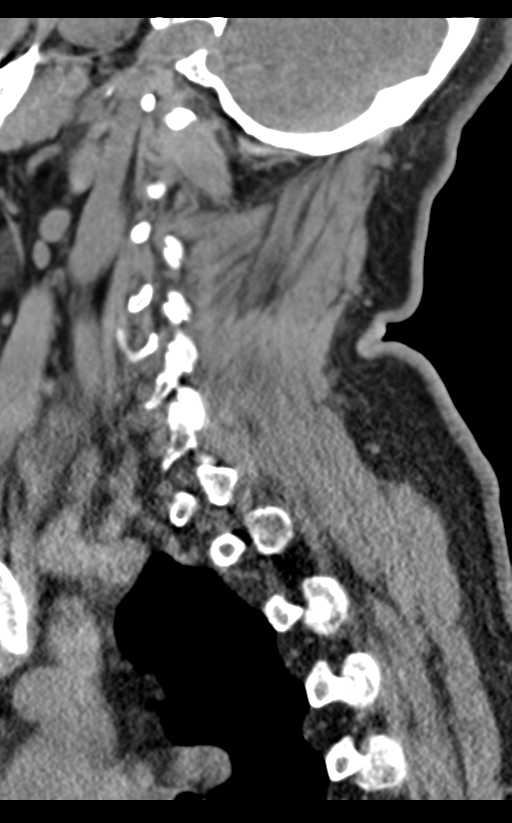 Cervical canal stenosis - OPLL and osteophytes (Radiopaedia 47329-51910 B 60).png
