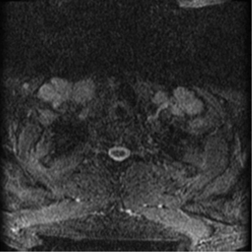 Cervical canal stenosis with cord compression (Radiopaedia 34114-35374 Axial Gradient Echo 1).png