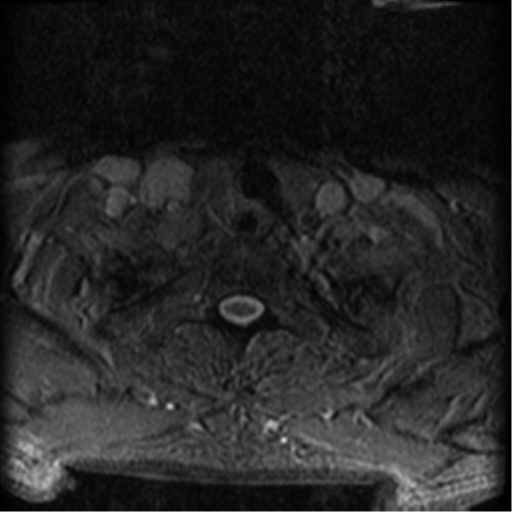 Cervical canal stenosis with cord compression (Radiopaedia 34114-35374 Axial Gradient Echo 5).png