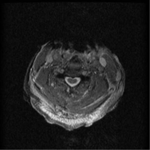 Cervical canal stenosis with cord compression (Radiopaedia 34114-35374 Axial Gradient Echo 50).png